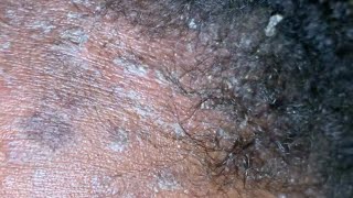 Flakes Scratching Natural Hair + Bonus Forehead Scratching.