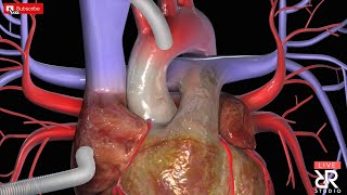 Coronary Artery Bypass Graft (CABG) "Surgeons View"  Unedited  (On Pump) MUST SEE......