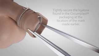 Circumplast Circumcision at Circumcision Centre, Bedfordshire & London, UK