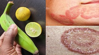 2 दिन में दाद खाज खुजली की छुट्टी कर देगा|Fungal infection treatment at home|dad khaj ka ilaj