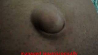 IRREDUCIBLE Umbilical Hernia