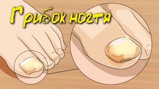 4 ЭФФЕКТИВНЫХ СРЕДСТВА от ГРИБКА НОГТЕЙ