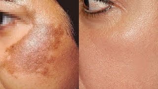 How To Use Potato To Treat Skin Pigmentation, Dark Spots, Acne Scars Easily At Home | Home Remedies