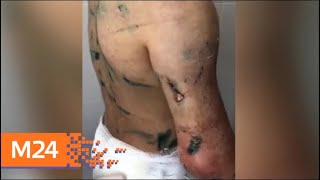 Девочку со шрамами и синяками из Ингушетии везут для лечения в Москву - Москва 24