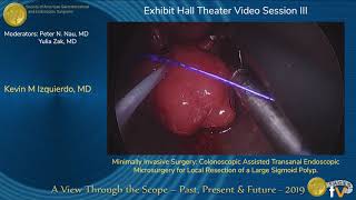 Colonoscopic Assisted Transanal Endoscopic Microsurgery for Local Resection of a Large Sigmoid Polyp