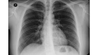 Chest x-ray - Heart failure, Kerly B lines, Pulmonary edema with Histology correlation