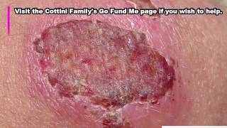 Deadly Flesh Eating Bacteria Outbreak in 2018!   MUST WATCH!!   ?