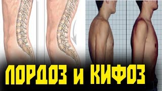 Кифоз Грудного Отдела И Лордоз Поясничного Отдела Позвоночника ! Исправление Осанки !