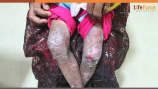 A Kid with Severe Epidermolysis Bullosa (EB) on Hands, Knees & Legs Treated
