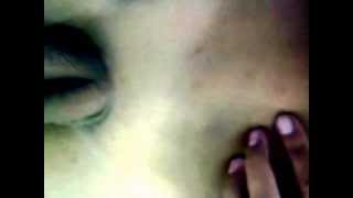 Varicocele with Spermatic Cord Varices (Dilated Veins)