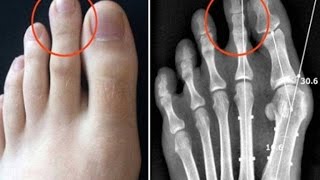 Only 14% of World Population Has Longer Second Toe and This Is Why.