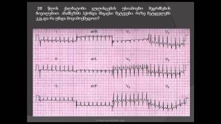 ეკგ / ავ კვანძოვანი რი-ენთრი ტაქიკარდია / ვალსალვის მანევრი, კაროტიდული სინუსის მასაჟი / ვეპაპამილი