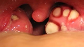 Worst Tonsil Stones?   Tonsillolith Questions and Answers