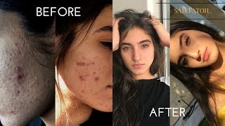 HOW TO GET CLEAR SKIN FAST | skin care routine | Sam Fatoh
