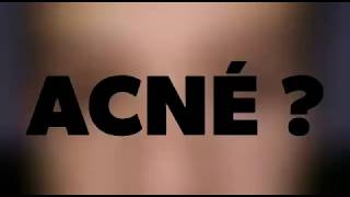 COMO ELIMINAR ACNE // CREMA EFECTIVA PARA EL ACNE // ELIMINA ACNE // ELIMINA MANCHAS DE ACNE //