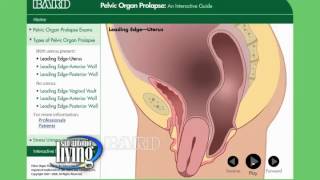 Understanding and treatment of Pelvic organ prol