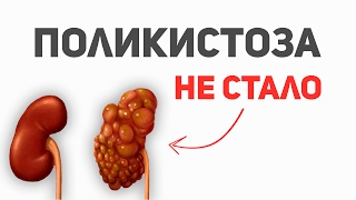 Поликистоза почек не стало.