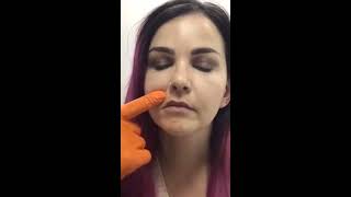 Aumento de labios y corrección de asimetría