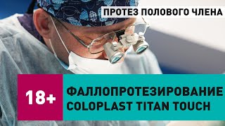 Фаллопротезирование 3 компонентный протез, протез полового члена, Coloplast Titan Touch