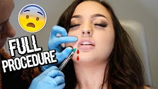 (LIVE FOOTAGE) GETTING LIP INJECTIONS / MY HONEST EXPERIENCE