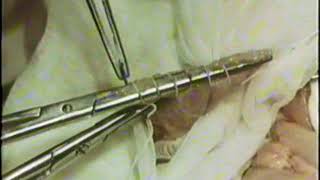 Шов Мойнигена,  закрытие культи 12 п. кишки © Moinigen's  suture, gastrectomy
