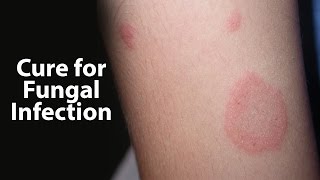 Cure for Fungal Infection | Zyropathy | Care World Tv