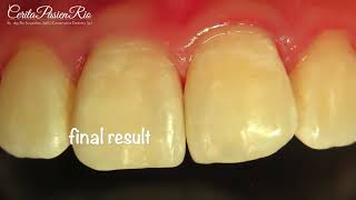 Midline anterior teeth caries restoration (penambalan gigi depan)