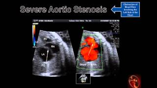 Fetal Echocardiography: Severe Aortic Stenosis
