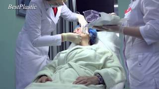 Инновационная подтяжка лица - 3D мезонити