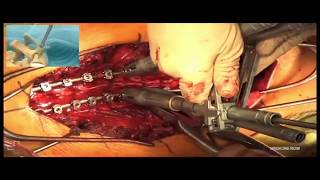 Cirugías de Espondilitis Anquilosante y Escoliosis #MedLife