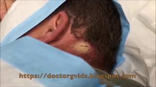 Dr. Cyst Buster's Pus-Filled MRSA Abscess (Denver, Extended Cut)