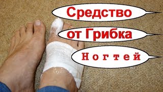 Грибок ногтей на ногах. Народное лечение грибка -ноготь лечу грибок - № 1