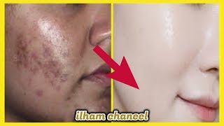 تبيض الوجه والجسم كله من أول دقيقه مهما كان الاسمرار والبقع الداكنه ستختفي قسما بالله مجربة ومضمونة