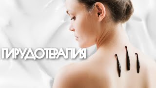ГИРУДОТЕРАПИЯ