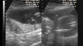 Resonancia Magnetica Parte 1, a los 5 meses 21 semanas de gestación. Maru BB Gomez