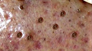 Amazing Blackheads Remover #11