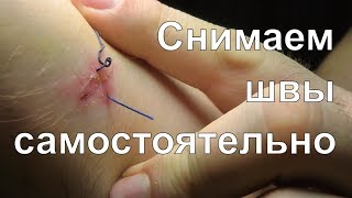 Квадрокоптер разрубил руку - снятие швов самостоятельно