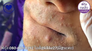 Выдавливание чёрных точек НОВОЕ! Чистка лица. Удаление и выдавливание прыщей. Лечение акне