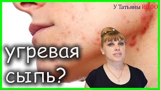 ЭФФЕКТИВНО!!! Как избавиться от АКНЕ (ПРЫЩЕЙ, УГРЕВОЙ СЫПИ) на лице!!!