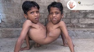 Conjoined Twins Shivanath and Shivram Run Faster Than You! ~ Body Bizarre!