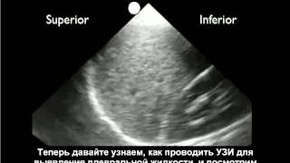 Порядок выполнения: ультразвуковое выявление плевральной жидкости