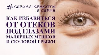 как убрать отеки под глазами, грыжи и  малярные мешки. омоложение глаз
