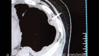 pleural biopsy