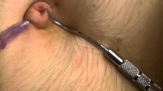 Navel Torture - dental pick and needle