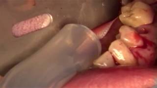 Avulsions de dents de sagesses et avulsion d'un kyste au niveau de la 45