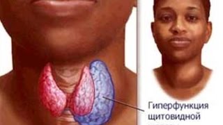 ***Дисфункция Щитовидной Железы***|***Disfunkcija Shhitovidnoj Zhelezy***