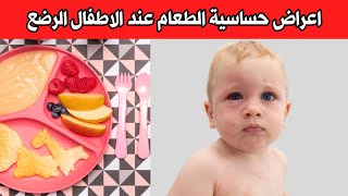 ما هي علامات حساسية الطعام عند الرضع و الاطفال و ما اسبابها ؟ | اعراض حساسية الحليب عند الرضع