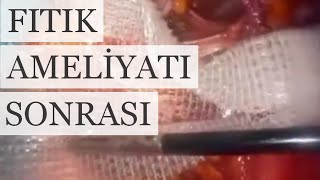 Laporoskopik Fıtık Ameliyatı Sonrası Hastayı Neler Bekler ?