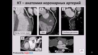 Компьютерная томография сердца или КТ-коронарография