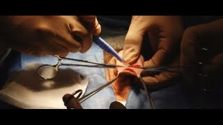 Circoncision au bloc opératoire - Dr Marc GALIANO